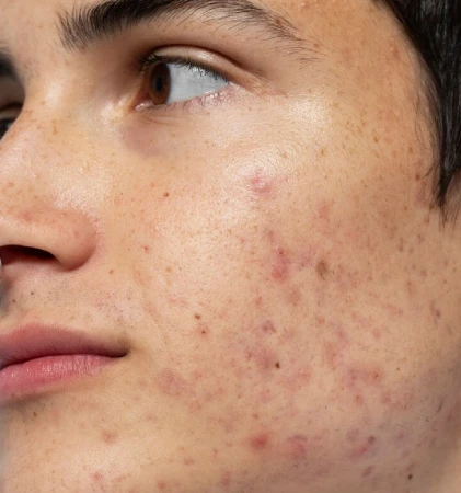 Acne Scar Reduction
