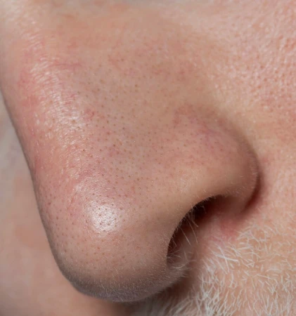 Open Pores