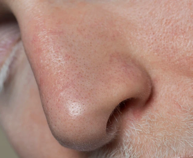 Open Pores Treatment in Ludhiana