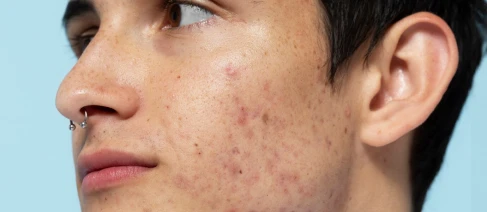Acne Scar Treatment in Gurgaon