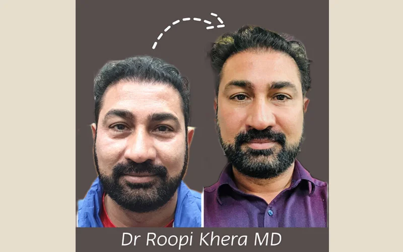 Hair Transplant