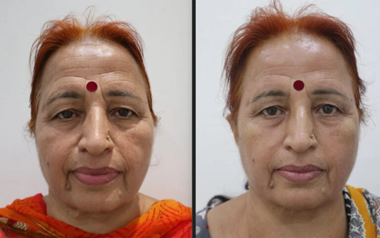 Plasma Pen Full Face