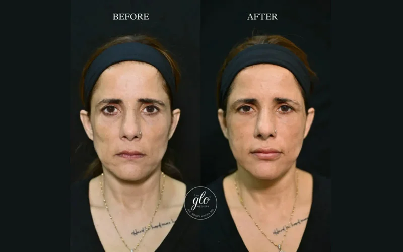 Anti-Aging / Facial Contouring