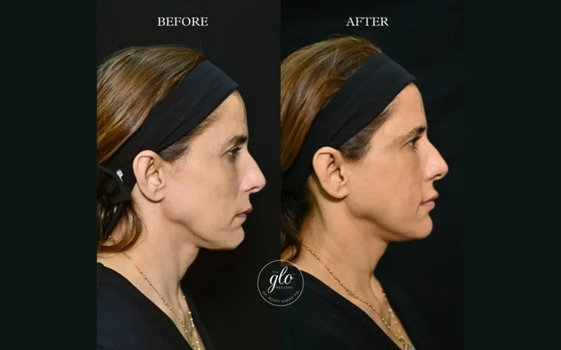 Anti-Aging / Facial Contouring