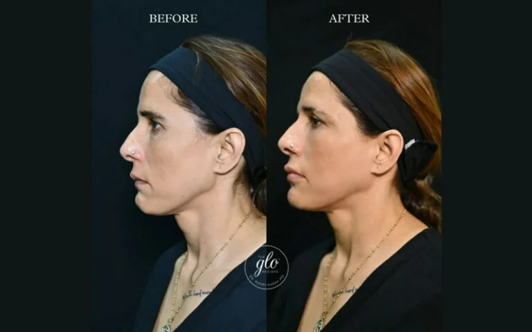 Anti-Aging / Facial Contouring