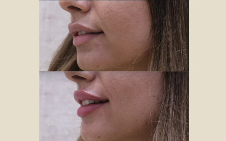 Lip Filler