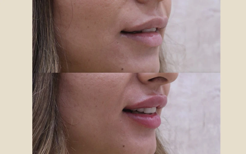 Lip Filler