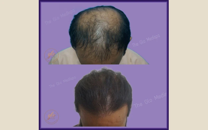 Hair Transplant