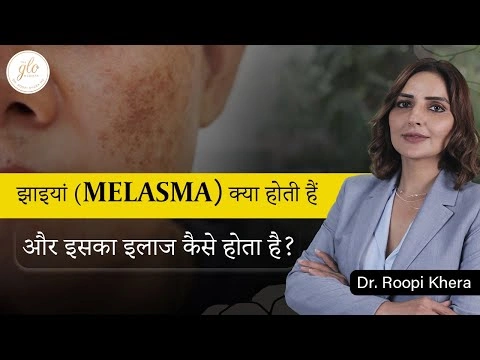 Melasma क्या है | झाइयों से कैसे पाएँ छुटकारा | Melasma Treatment in Ludhiana | Dr. Roopi Khera